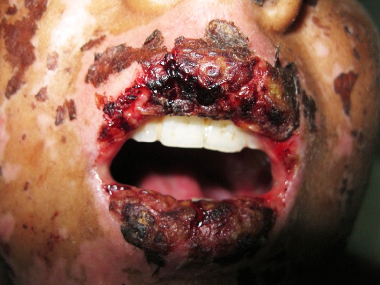 1st_pt_before_tratment-820