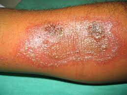 Dermatitis paederus